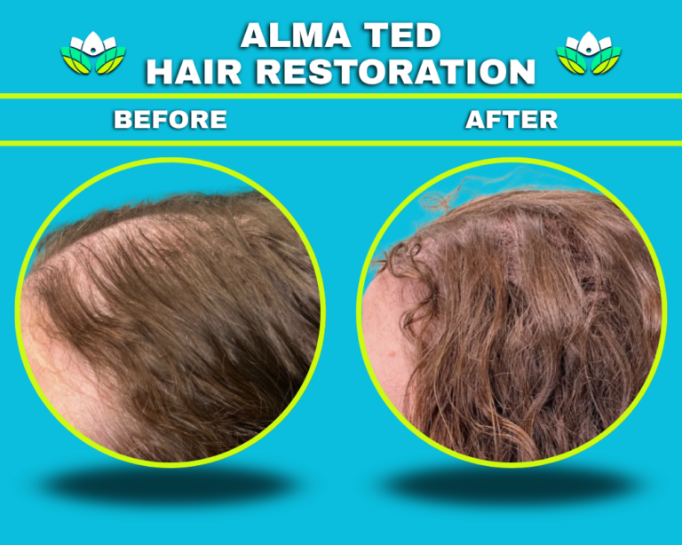 Hair Restoration