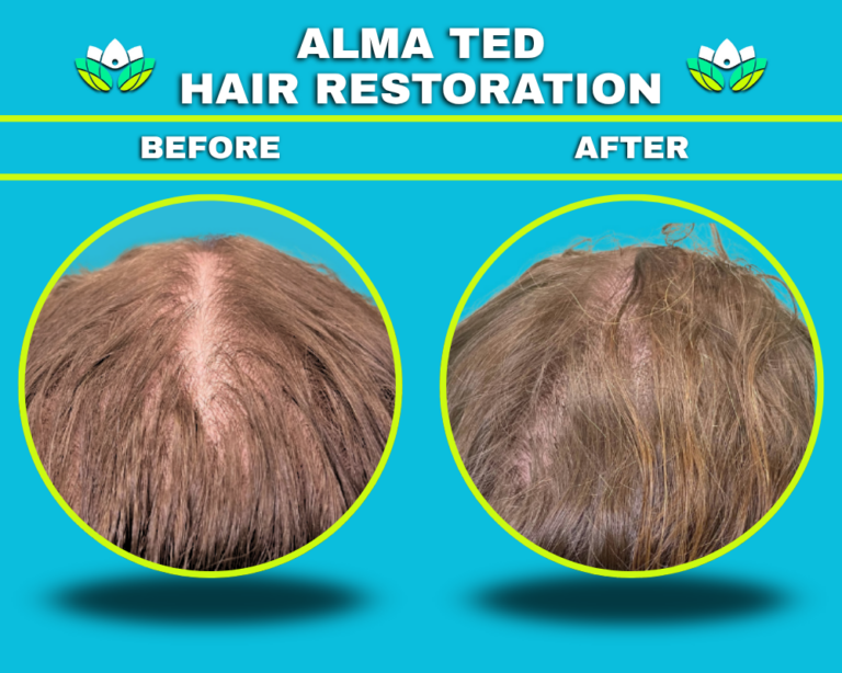 Hair Restoration
