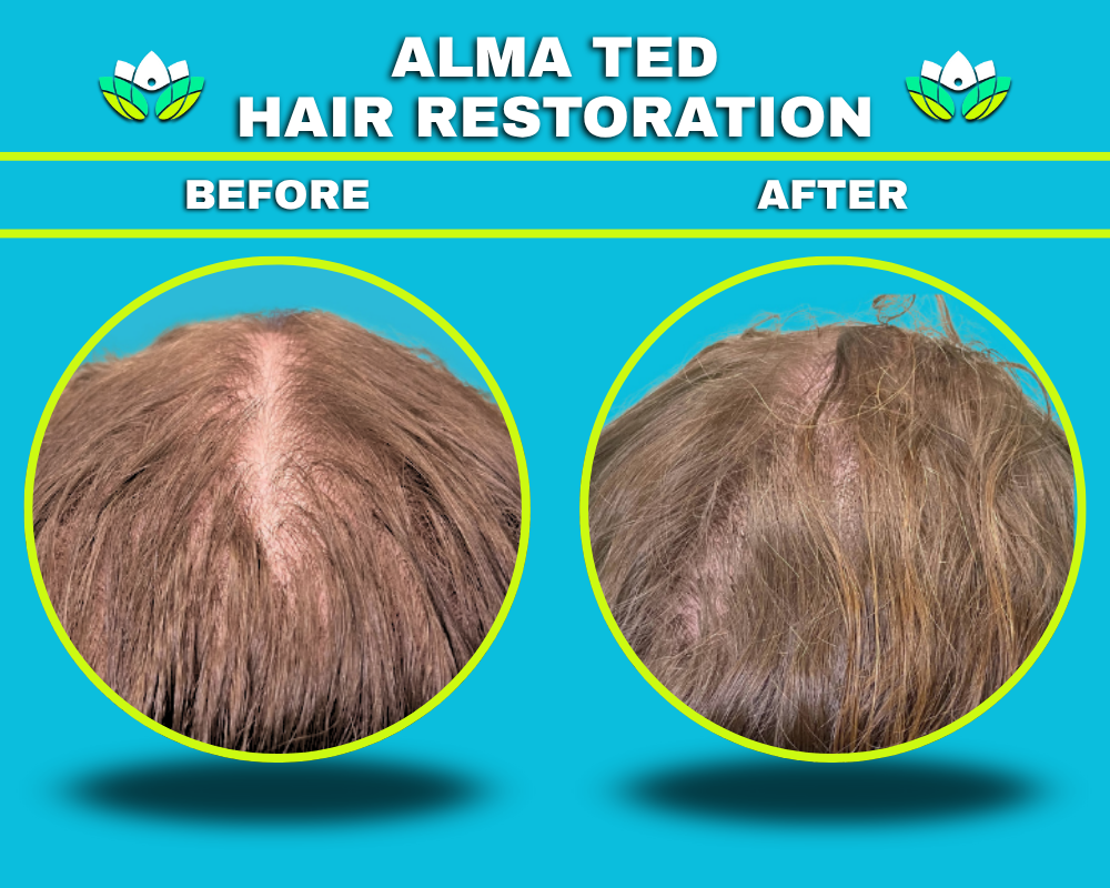 Hair Restoration
