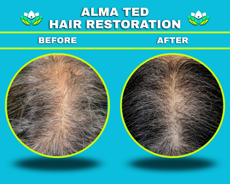 Hair Restoration