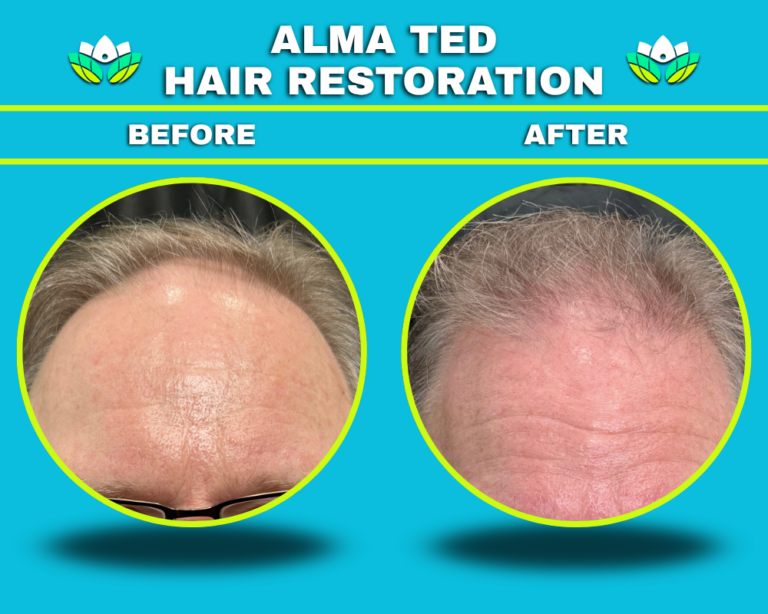 Male - Hair Restoration