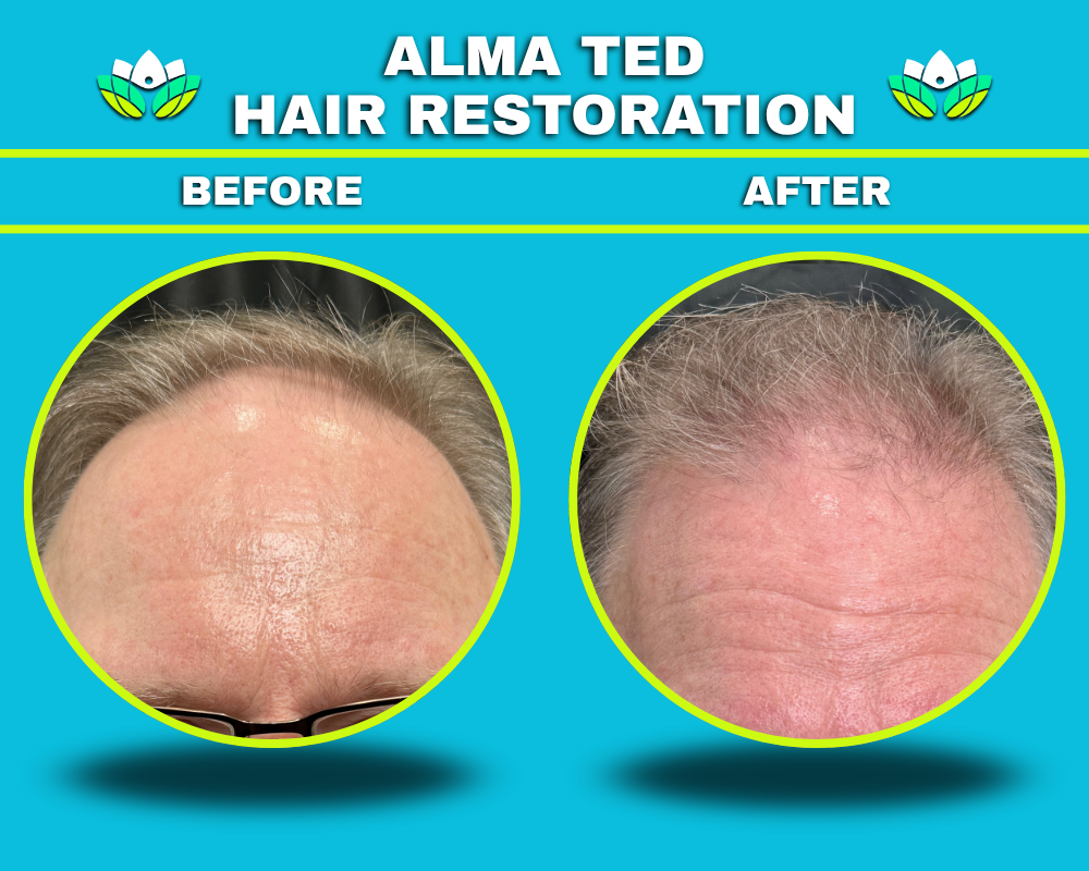 Male - Hair Restoration