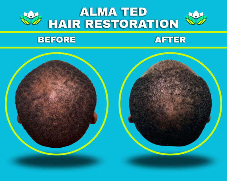 Hair Restoration