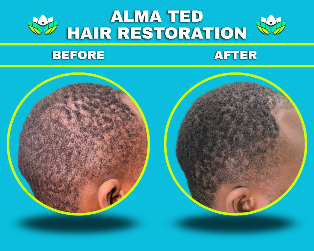Male Hair Restoration