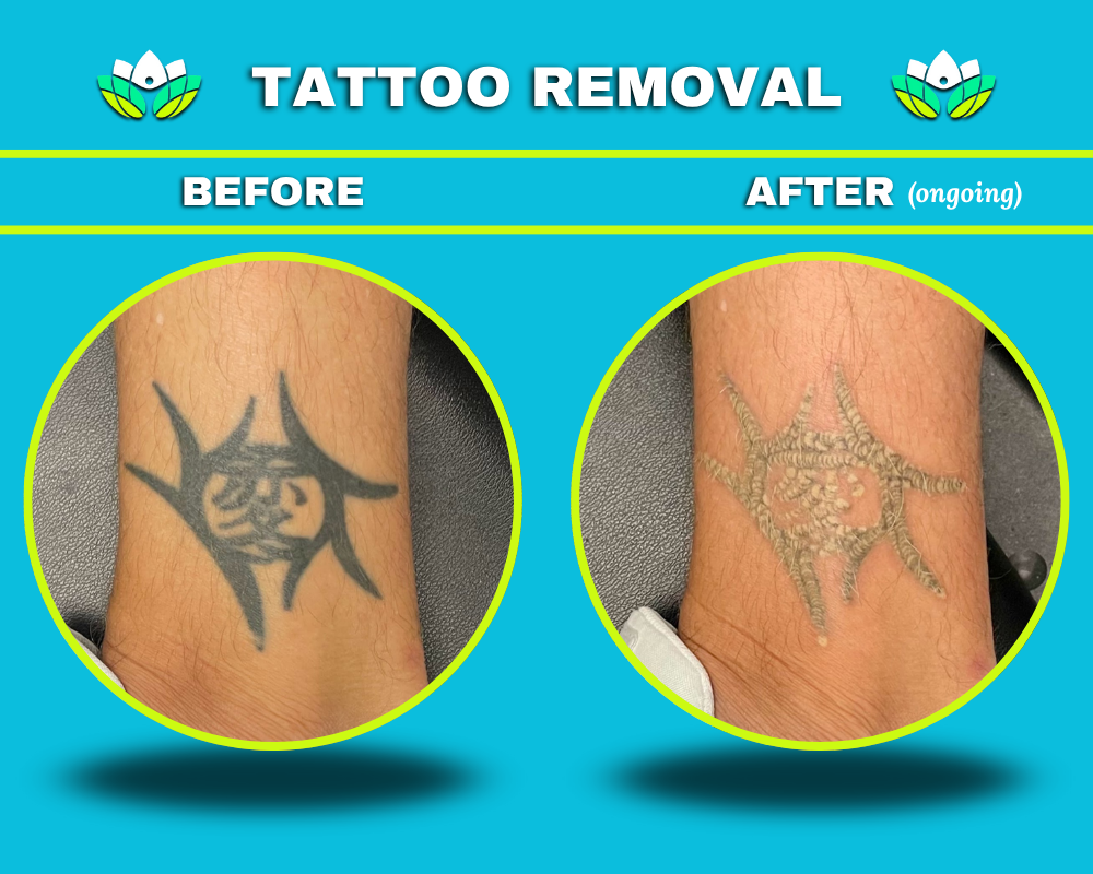 Tattoo Removal Male Ankle