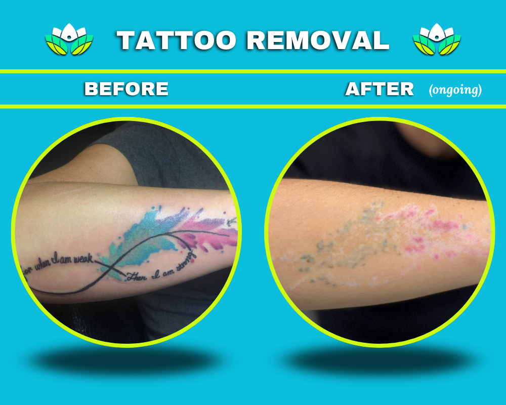 Tattoo Removal - Forearm