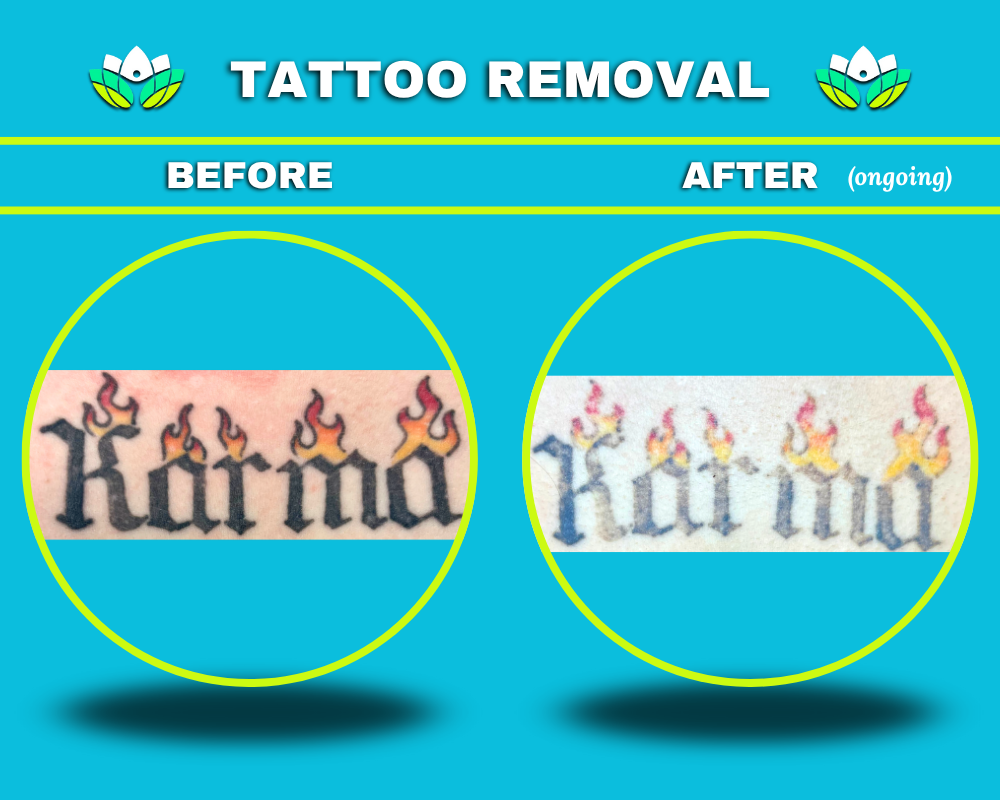 Tattoo Removal - Chest