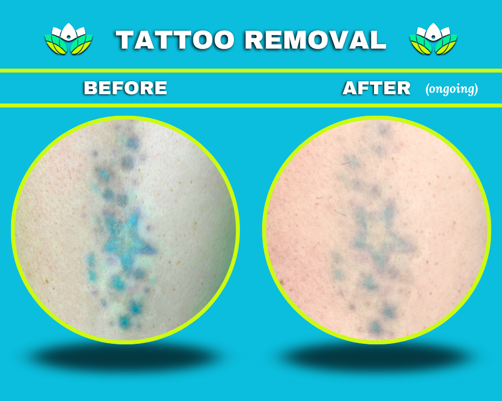 Tattoo Removal Female Arm