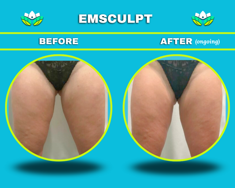 EmSculpt Body Contouring