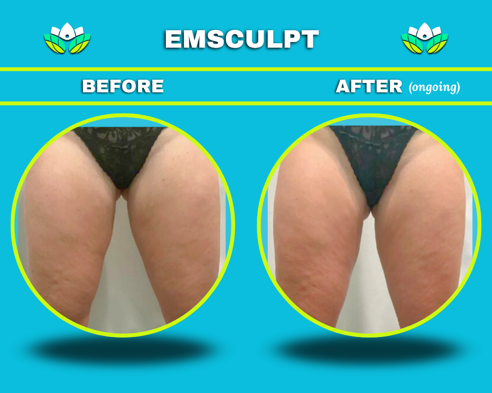 EmSculpt Body Contouring