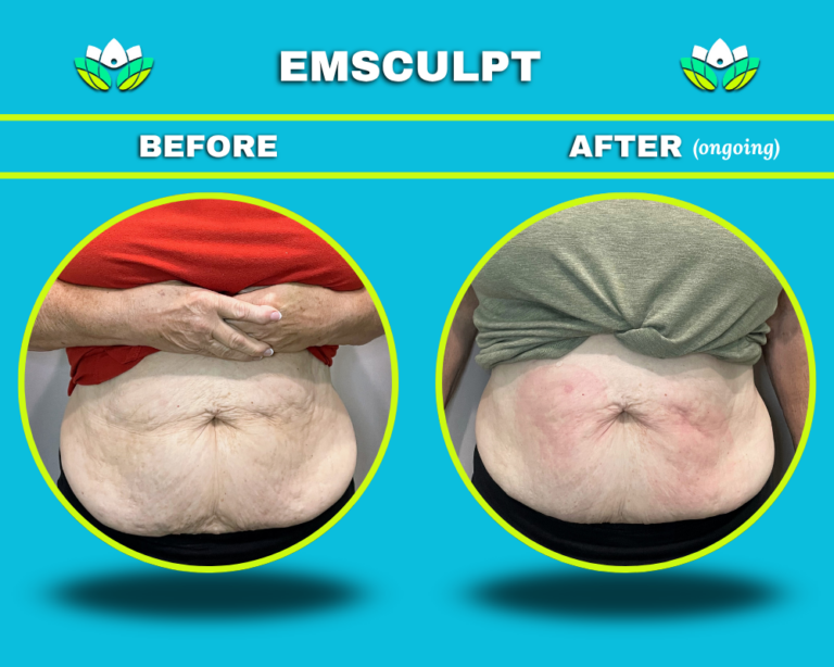 EmSculpt Body Contouring - Stomach
