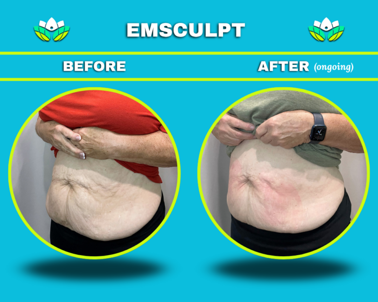 EmSculpt - Abdomen - Stomach