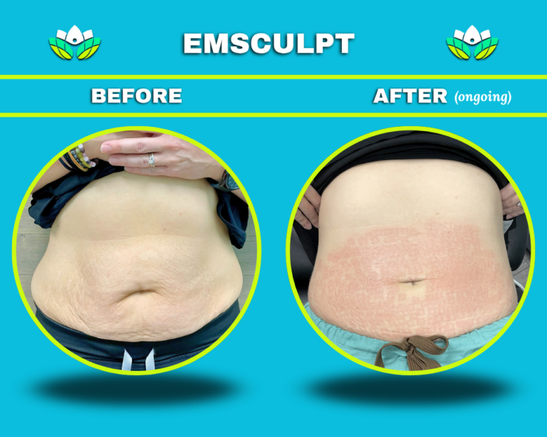 EmSculpt Stomach